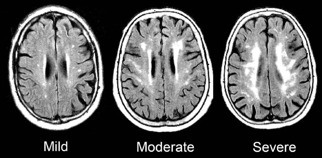 Agyi kisérbetegség - vascularis encephalopathia